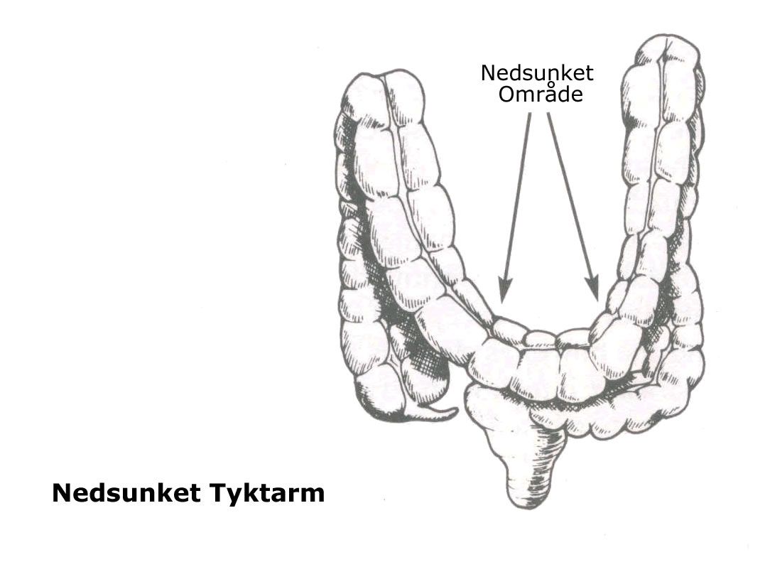 Nedsunket tyktarm